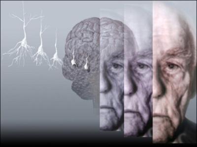 alzheimer-revertido-pela-primeira-vez